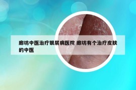 廊坊中医治疗银屑病医院 廊坊有个治疗皮肤的中医