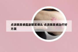 点滴银屑病是副银屑病么 点滴银屑病治疗好方案