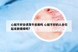 心脏不好会诱发牛皮癣吗 心脏不好的人会引起皮肤瘙痒吗?