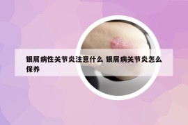 银屑病性关节炎注意什么 银屑病关节炎怎么保养