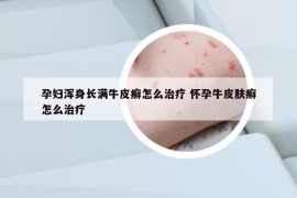 孕妇浑身长满牛皮癣怎么治疗 怀孕牛皮肤癣怎么治疗