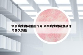 银屑病生物制剂副作用 银屑病生物制剂副作用多久消退