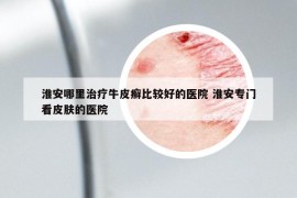 淮安哪里治疗牛皮癣比较好的医院 淮安专门看皮肤的医院
