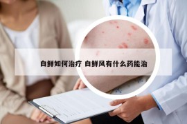 白鲜如何治疗 白鲜风有什么药能治