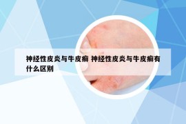 神经性皮炎与牛皮癣 神经性皮炎与牛皮癣有什么区别