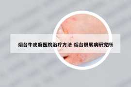 烟台牛皮癣医院治疗方法 烟台银屑病研究所
