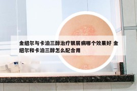 金纽尔与卡泊三醇治疗银屑病哪个效果好 金纽尔和卡泊三醇怎么配合用