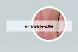 治牛皮癣有个什么霉素