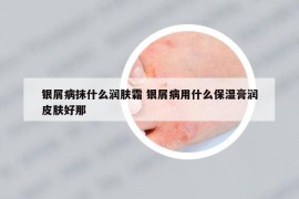 银屑病抹什么润肤霜 银屑病用什么保湿膏润皮肤好那