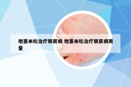 地塞米松治疗银屑病 地塞米松治疗银屑病用量