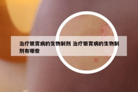 治疗银霄病的生物制剂 治疗银霄病的生物制剂有哪些