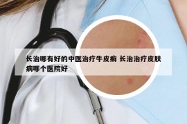长治哪有好的中医治疗牛皮癣 长治治疗皮肤病哪个医院好