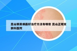 昆山银屑病最好治疗方法有哪些 昆山正规皮肤科医院