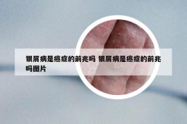 银屑病是癌症的前兆吗 银屑病是癌症的前兆吗图片