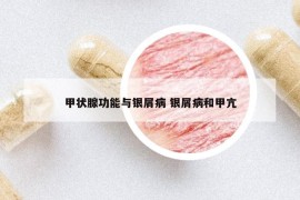 甲状腺功能与银屑病 银屑病和甲亢