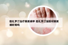 他扎罗汀治疗银屑病甲 他扎罗汀凝胶对银屑病好用吗