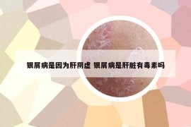 银屑病是因为肝阴虚 银屑病是肝脏有毒素吗