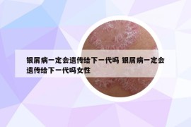 银屑病一定会遗传给下一代吗 银屑病一定会遗传给下一代吗女性