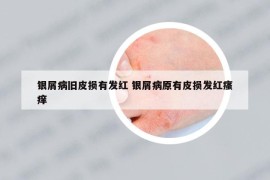 银屑病旧皮损有发红 银屑病原有皮损发红瘙痒