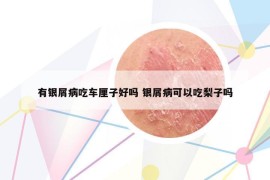 有银屑病吃车厘子好吗 银屑病可以吃梨子吗