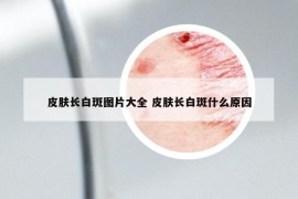 皮肤长白斑图片大全 皮肤长白斑什么原因
