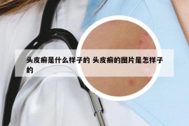 头皮癣是什么样子的 头皮癣的图片是怎样子的