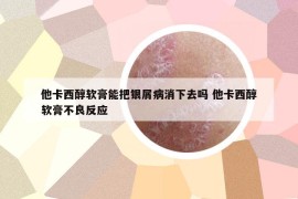 他卡西醇软膏能把银屑病消下去吗 他卡西醇软膏不良反应