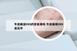 牛皮癣涂999药膏有用吗 牛皮癣用999皮炎平