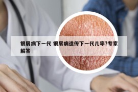 银屑病下一代 银屑病遗传下一代几率?专家解答