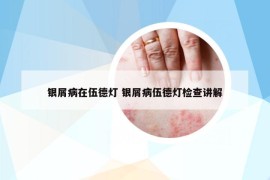 银屑病在伍德灯 银屑病伍德灯检查讲解