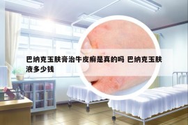 巴纳克玉肤膏治牛皮癣是真的吗 巴纳克玉肤液多少钱