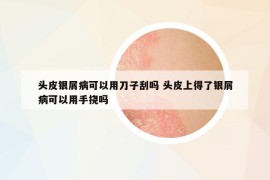 头皮银屑病可以用刀子刮吗 头皮上得了银屑病可以用手挠吗