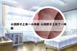 小孩脖子上有一小块癣 小孩脖子上长了一块癣