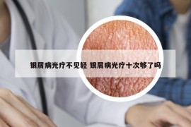 银屑病光疗不见轻 银屑病光疗十次够了吗