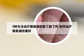 5种方法治疗银屑病你都了解了吗 如何治疗银屑病效果好