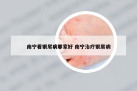 南宁看银屑病那家好 南宁治疗银屑病