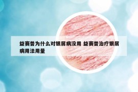 益赛普为什么对银屑病没用 益赛普治疗银屑病用法用量