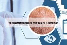 牛皮癣是啥原因得的 牛皮癣是什么原因造成