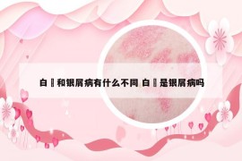 白疕和银屑病有什么不同 白疕是银屑病吗