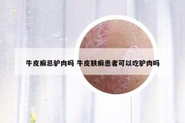 牛皮癣忌驴肉吗 牛皮肤癣患者可以吃驴肉吗