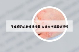 牛皮癣的火针疗法视频 火针治疗银屑病视频
