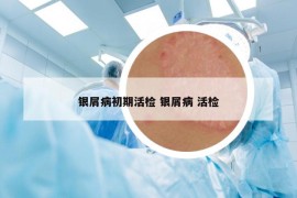 银屑病初期活检 银屑病 活检