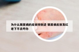为什么银屑病的皮损特别烫 银屑病皮损发红老下不去咋办