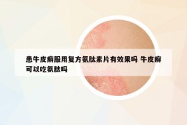 患牛皮癣服用复方氨肽素片有效果吗 牛皮癣可以吃氨肽吗