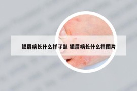 银屑病长什么样子粼 银屑病长什么样图片