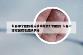 长春哪个医院看皮肤病比较好的医院 长春市哪家医院看皮肤病好