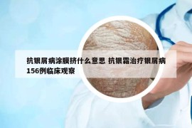 抗银屑病涂膜挤什么意思 抗银霜治疗银屑病156例临床观察