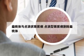 扁桃体与点滴状银屑病 点滴型银屑病割除扁桃体