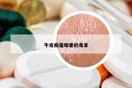 牛皮癣是哪里的毒素