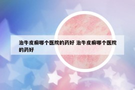 治牛皮癣哪个医院的药好 治牛皮癣哪个医院的药好